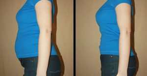 Fodmaps Diet: If Chronic Bloating or IBS Is Ruining Your Life, Try This irritable bowel syndrome treatment