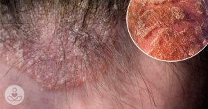 Scalp Eczema: 8 Natural Remedies for Red, Flaky, or Itchy Scalps RF_July09_17_Itchy-Scalps