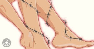 The Connection Between Fibromyalgia and Leg Pain Sep24_Part01_01_Fibromyalgia