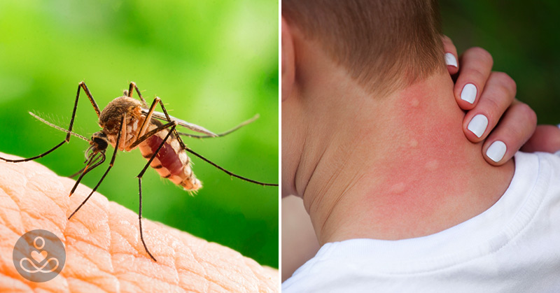 Mosquito biting causing Skeeter Syndrome