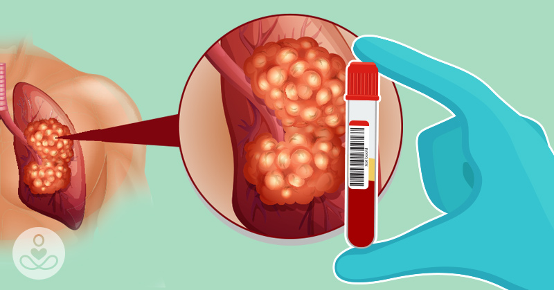 Finally! Blood Test Could Catch Lung Cancer Before It’s Too Late - Featured image