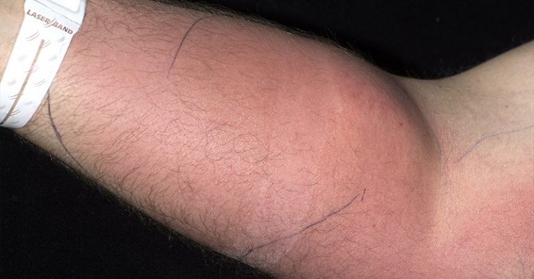A Man Was Once Hospitalized After Injecting Semen Into His Arm to ‘Cure Back Pain’ - Featured image