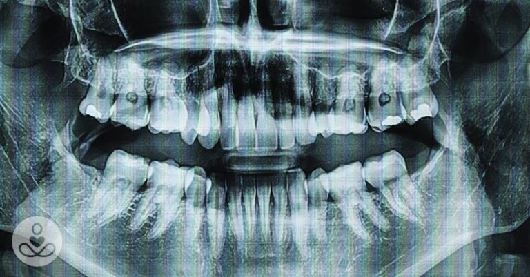 Scientist May Have Discovered a Drug that Fixes Cavities and Regrows Teeth - Featured image