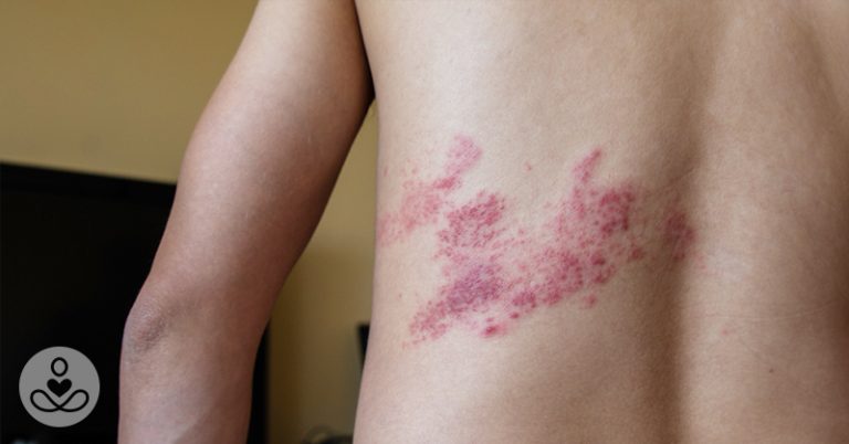 Too Young for Shingles? Not for This 36-year old - Featured image