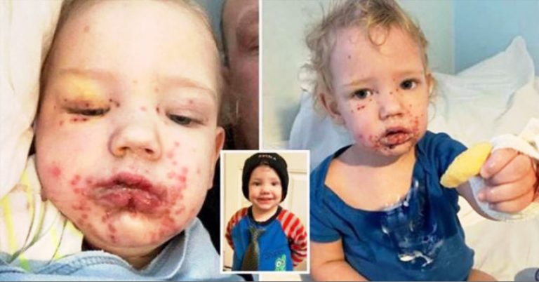 The Deadly Kiss: Toddler Hospitalized After His Face Was Ravaged By Herpes - Featured image