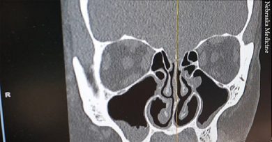 Two And A Half Years Later, Woman’s Chronic Runny Nose Turned out to Be