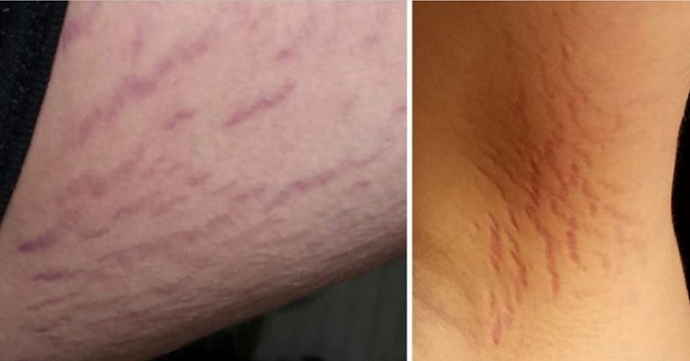 Misdiagnosis: Rare Cat Scratch Disease Was Actually the Cause Of Teen’s Schizophrenia-Like Symptoms, Report Says - Featured image