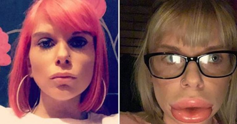 Dangers of Lip Fillers: Mother Ends Up in Hospital After At-Home Treatment - Featured image