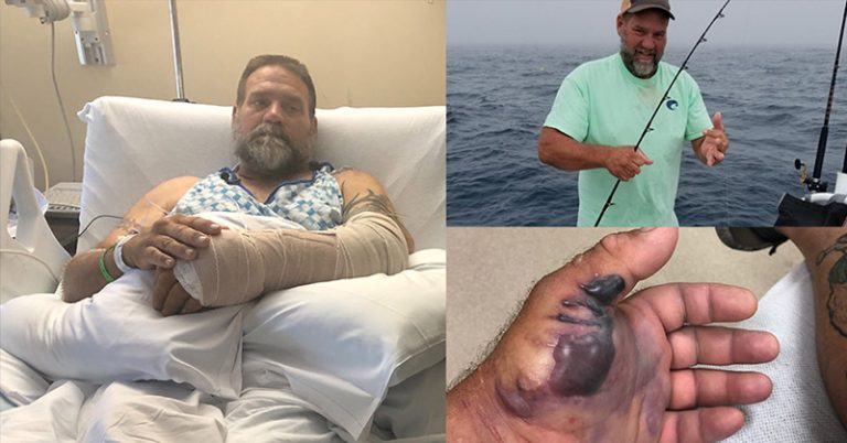 Flesh-Eating Bacteria Infects Florida Man Fishing Off the Coast Of Palm Harbor in the Gulf of Mexico - Featured image