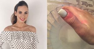 'Bruise' turned out to be deadly melanoma hiding on 21-year-old's nail bruised-nail