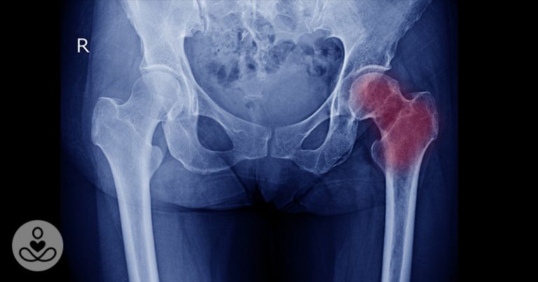 Does High Intake of Vitamins B6 and 12 Increase Hip Fracture Risk? - Featured image