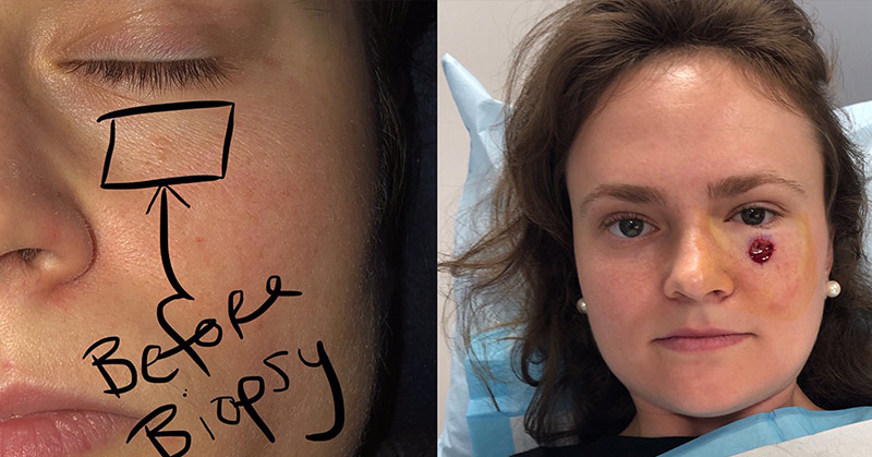split screen of woman with pimple under eye that turned into cancer