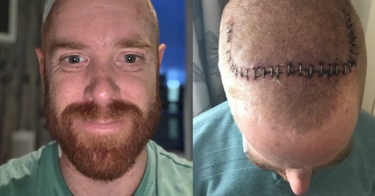 Deep Brain Stimulation: Adelaide Man Receives ‘Pacemaker for the Brain’ To Combat Young Onset Parkinson’s Disease - Featured image