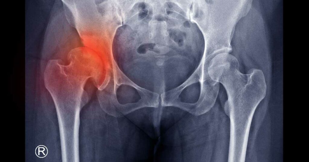 What Happens When You Break a Hip? (and How to Avoid a Hip Fracture) - Featured image
