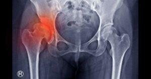 What Happens When You Break a Hip? (and How to Avoid a Hip Fracture) broken hip radiograph xray
