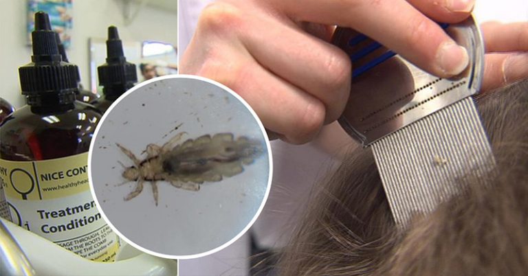 “Super Lice”: Chemical-Resistant Head Lice On the Rise - Featured image