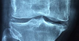 Could Exercise Prevent Arthritis? New Research Is Hopeful x-ray of bones