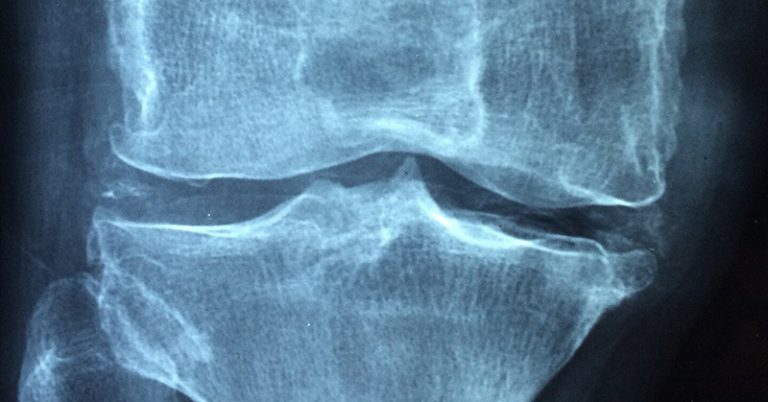 Could Exercise Prevent Arthritis? New Research Is Hopeful - Featured image