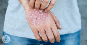 skin peeling off hand due to scratching from Eczema