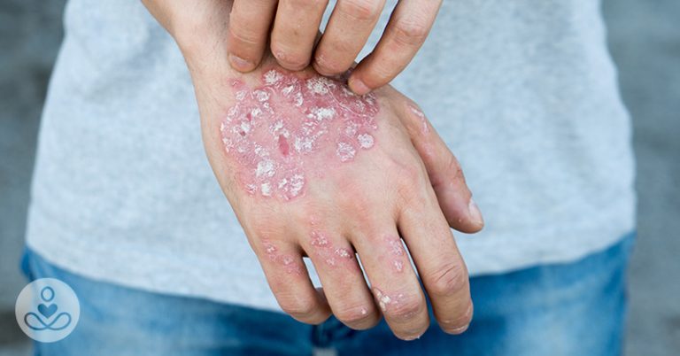9 Foods That Could Make Eczema Worse (And Many That Can Help) - Featured image