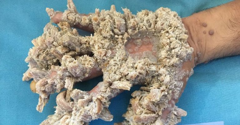 Patient With ‘Tree Man’ Syndrome Says He ‘Can Finally Live A Normal Life’ - Featured image