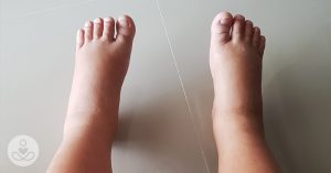 swollen feet