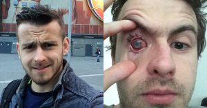 Man Is Left Blind After He Had A Shower With His Contact Lenses In split screen sjowing face of man smiling and inflamed eye