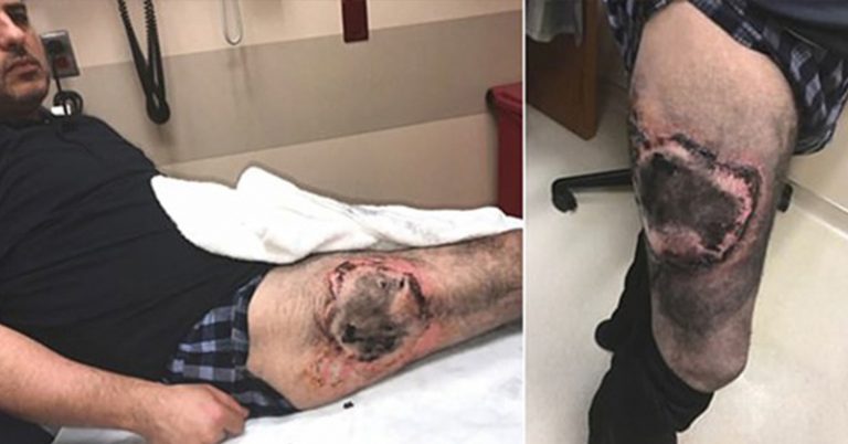 Vape Pen Explodes in Man’s Pocket, Leaving Him with Excruciating Third-Degree Thigh Burns - Featured image