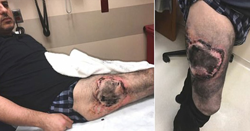 hole burned into the leg of a man as a result of a vape pen exploding