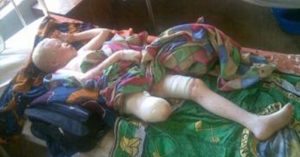Albinos Hunted in Tanzania and Malawi albino person missing a limb lying on a bed covered in quilts