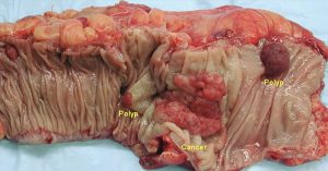 Resistant Starches, Good Bacteria, and Colon Cancer—What You Need to Know colon with polyps and cancer