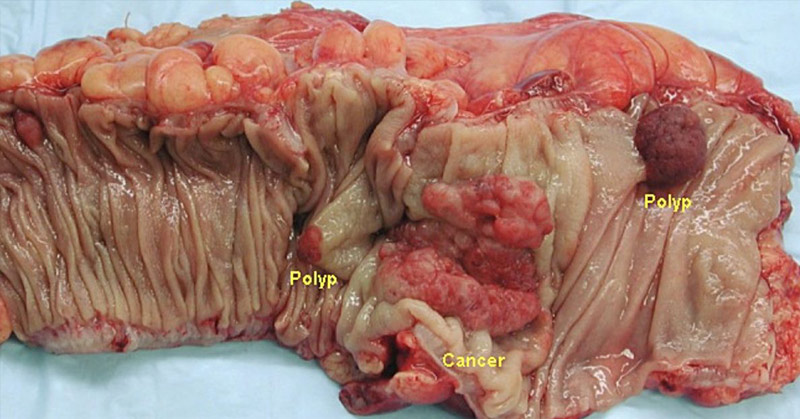 colon with polyps and cancer
