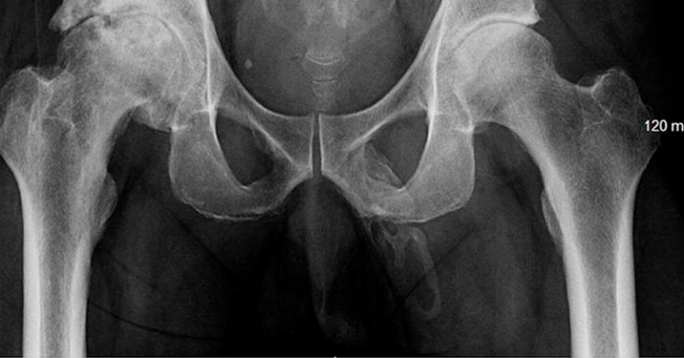 An X-Ray Reveals Bone Forming in Man’s Penis - Featured image