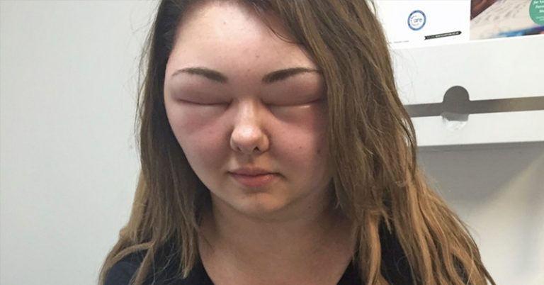 Woman’s Face Swells Three Times Usual Size After Using Organic Hair Dye - Featured image