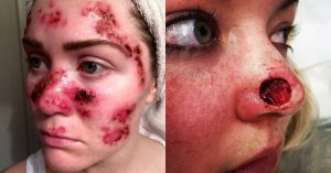skin cancer due to tanning beds