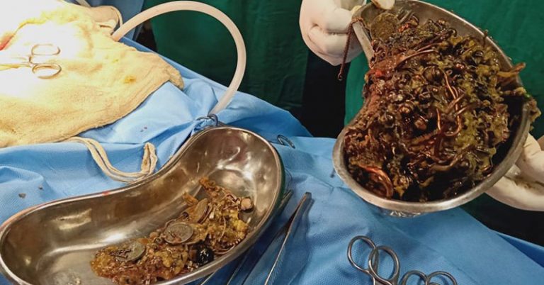 Doctors Found Over $64,000 of Jewelry in Woman’s Stomach - Featured image