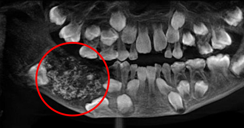xray of mouth showing teeth