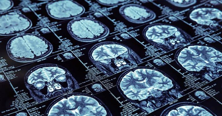Memory Loss from Alzheimer’s Reversed by Head Device Using Electromagnetic Waves - Featured image