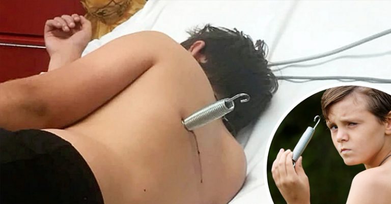 Freak Accident on A Trampoline Left 12-Year-Old British Boy with A Spring Buried 6cm in His Back - Featured image