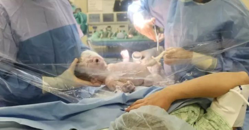 Hospitals Using Clear C-Section Drapes To Let Moms Meet Their Babies in a New Way