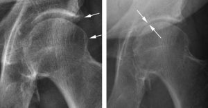 steroid injections to joints