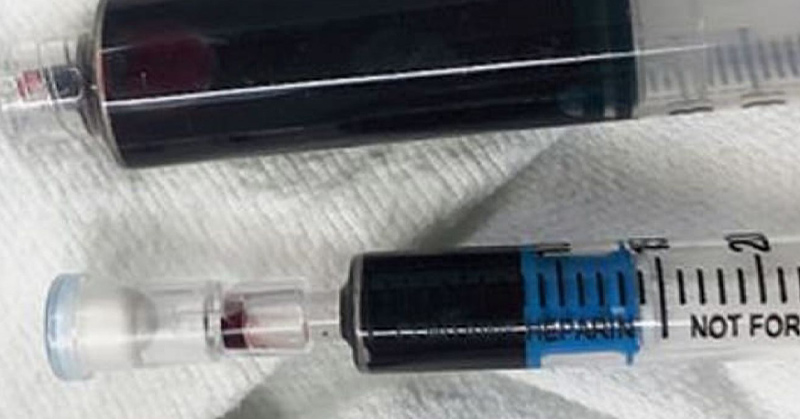 blue blood in syringe