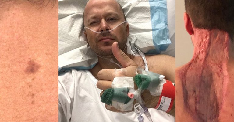 Man urges others to be vigilant after neck spot turns out to be skin cancer - Featured image