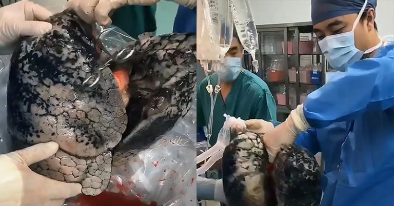 Shocking Video Showing Lungs of 52-Year-Old Chain Smoker. ‘The Best Anti-Smoking Add Ever’ - Featured image