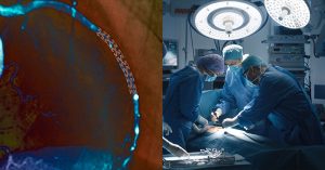 surgery for blocked arteries often unwarranted