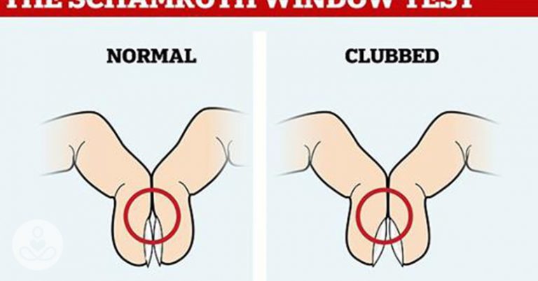 Finger Test For Lung Canc*r Could Determine Canc*r Risk