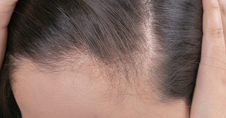 Natural Home Remedies for Hair Growth (Men and Women) - Featured image