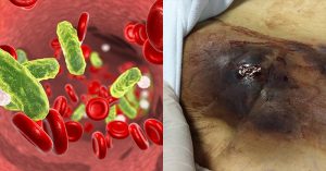 Sepsis Causes Far More Deaths Than Thought sepsis