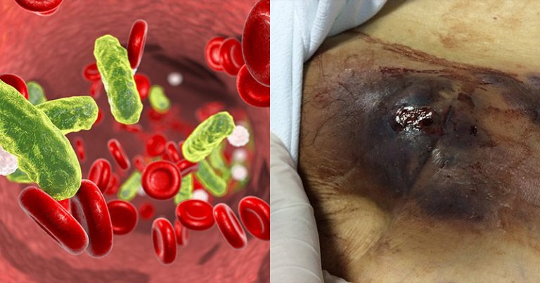 Sepsis Causes Far More Deaths Than Thought - Featured image