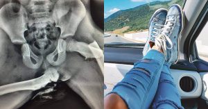 Woman's hips are crushed in a crash after she propped her feet up on the dashboard legs crushed after propping feet on dashboard